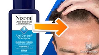 Should you use Ketoconazole Shampoo for Hair Loss Featuring Steve Cook [upl. by Ulla]