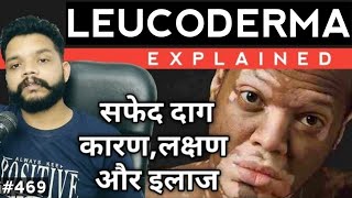 Leucoderma  Vitiligo  White Spots Explained In Hindi  Leucoderma Causes amp Treatment [upl. by Bogosian398]