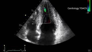 Apical Hypertrophic Cardiomyopathy  Yamaguchi Syndrome Echo  HCM [upl. by Ynattir833]