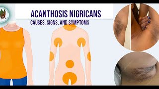 Acanthosis Nigricans Causes Signs and Symptoms [upl. by Blanding]