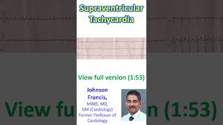 Supraventricular Tachycardia [upl. by Nerdna]