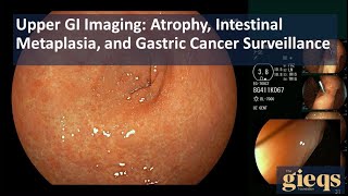 Upper GI Imaging Atrophy Intestinal Metaplasia and Gastric Cancer Surveillance [upl. by Octavie]