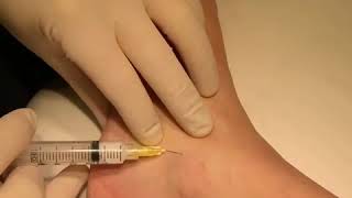 Sclerotherapy Spider Vein Treatment  Inovia Vein Specialty Centers [upl. by Ynar567]