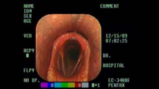 Normal Larynx mpg [upl. by Garzon]