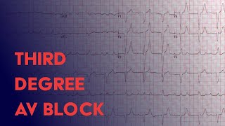 Third Degree Complete Heart Block  EKG ECG Interpretation [upl. by Quent]