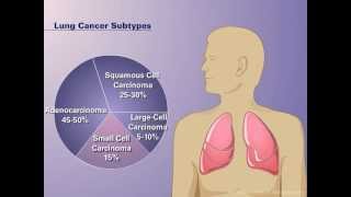 The Pathophysiology of Nonsmall Cell Lung Cancer [upl. by Shriver510]