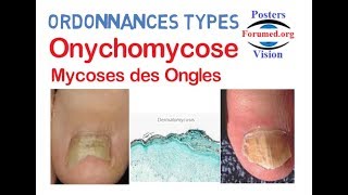 Onychomycose traitement des Ongles infectés par les champignons Ordonnances Types [upl. by Griff]