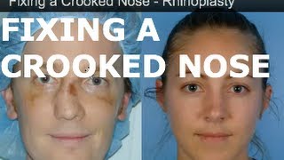 Fixed a Crooked Nose – Rhinoplasty in San Francisco – Dr David Kim [upl. by Nnaeilsel]