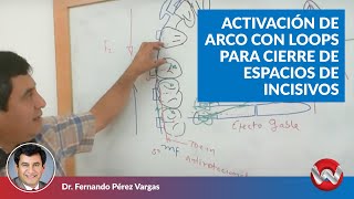 Activación de arco con loops para cierre de espacios de incisivos [upl. by Bourgeois]