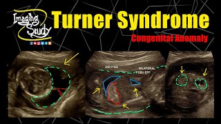 Turner Syndrome  45X  Monosomy X  Ultrasound  Anomaly  Case 276 [upl. by Rafaellle]