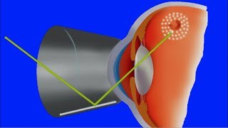 Agujeros y Desgarros de la retina Cuerpos flotantes moscas y luces Clínica Bonafonte [upl. by Missy329]