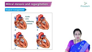 Mitral Stenosis amp Mitral Regurgitation Hindi  Internal Medicine🫀🫀🫀 [upl. by Leasi506]