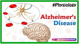 Alzheimers disease  Etiology Pathophysiology Signs and symptoms Diagnosis and Treatment [upl. by Lorsung]