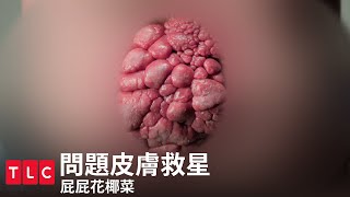 《問題皮膚救星》屁屁花椰菜，看不見不代表不存在的痛｜TLC 旅遊生活頻道 [upl. by Ahsiekram981]