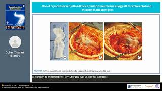 Use of cryopreserved ultrathick amniotic membrane allograft for colorectal and intestinal anastomose [upl. by Coleman890]