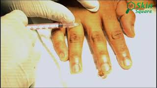 Electrodessication of Pyogenic Granuloma Skin Tumour From Finger Tip  স্কিন স্কয়ার  Dr Sabbir [upl. by Ydnelg]