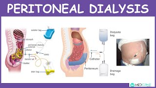 Peritoneal Dialysis Introduction Physiology Technique Modes and Complications [upl. by Warenne]