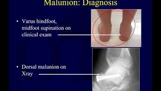 Talus fractures 3  complications of talar neck fx OTA lecture series III l14c [upl. by Eliades]