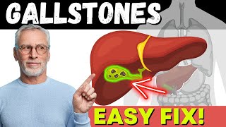 DISSOLVE GALLSTONES Permanently [upl. by Ani]