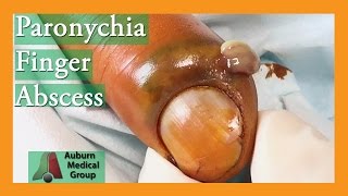 Paronychia Fingernail Abscess Infection Treatment  Auburn Medical Group [upl. by Caravette]