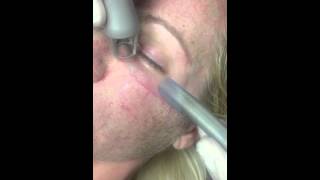 CO2 laser resurfacing for acne wrinkles pores skin tightening complexion tone lines facial [upl. by Leitnahs]