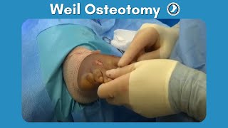 Weil Osteotomy Performed by Dr Paul Steinke [upl. by Navnod334]