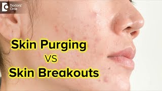 What is skin purging  Is it the same as skin breakouts  Dr Rajdeep MysoreDoctors Circle [upl. by Bedell497]