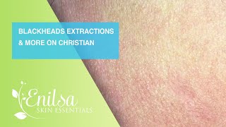 Blackheads Extractions and more on Christian [upl. by Enirehs]