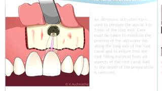 Endodontic Microsurgery [upl. by Menken]