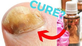 Fast Toenail Fungus Cure  How to Get Rid of Toenail Fungus With Nail Fungus Treatment [upl. by Murdoch]