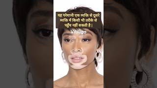 Vitiligo मन को अत्यंत ही ज्यादा दुख पहुंचाने वाली परेशानी है vitiligo vitiligotreatment whitespot [upl. by Noet]