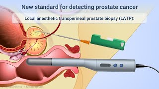 Transperineal Prostate Biopsies Under Local Anesthesia [upl. by Capone503]