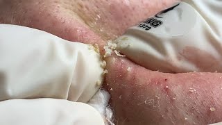 Acne Treatment Huong Da Nang576  2023 [upl. by Leizar]