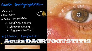 Acute Dacryocystitis  lacrimal system [upl. by Studnia500]