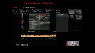 varicocele sinistro di 4° grado [upl. by Osbert262]