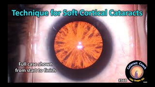 Complete Cataract Case Technique for Soft Cortical Cataracts [upl. by Albers947]