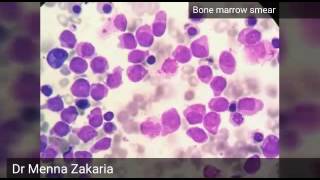 Acute Myeloid Leukemia AML M3 [upl. by Thea]