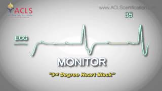 Third Degree Heart Block by ACLS Certification Institute [upl. by Ellened148]