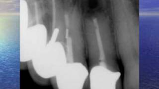 Fistula Could Trick You  Three Endodontic Cases [upl. by Bautram]