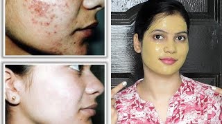 Remove PIMPLESACNEDARK SPOT instantly with multani mitti face pack in summerTipsToTop By Shalini [upl. by Etnahs254]