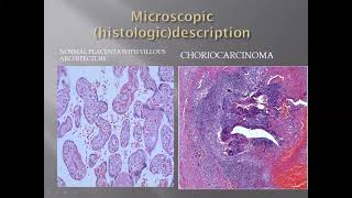 Histology of Choriocarcinoma [upl. by Seabury]