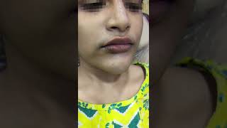 Lip filler treatment in Kolkata youtubereels youtubeshorts youtubevideo kolkatafashion kolkata [upl. by Pardner]