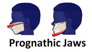 Treatment of Prognathic Jaw Jaw Pushing Forward by Prof John Mew [upl. by Atiana]