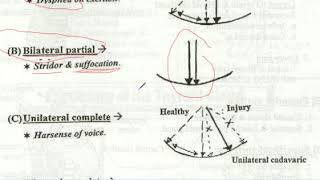 recurrent laryngeal nerve injury paralysis palsy [upl. by Ashman]