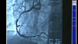 Cardiac Cath with Angioplasty [upl. by Ethban]