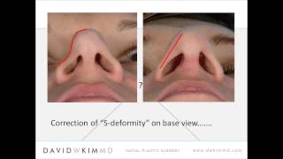 The interface of form and function in tip rhinoplasty [upl. by Conant]