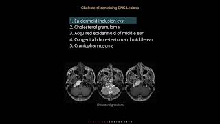 Cholesterol lesions in CNS  Radiology Tutorials  1000 cases in 100 days Case 01 [upl. by Hsotnas526]