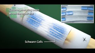 Nerve Repair with NeuraGen Nerve Guide from Integra Life Sciences  Ghost Medical [upl. by Sainana]