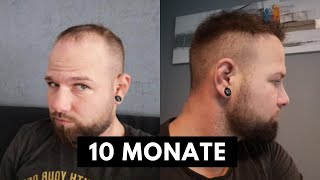 Haartransplantation 10 Monate nach der Op in einer Minute [upl. by Aleac]