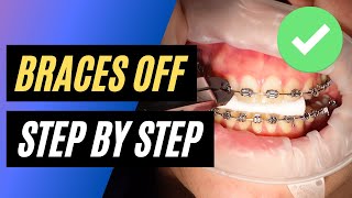 BRACES OFF  Step by step orthodontic removal [upl. by Seabrooke610]